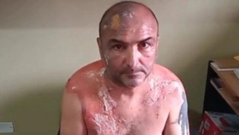 Una mujer atacó a su ex esposo con agua hirviendo