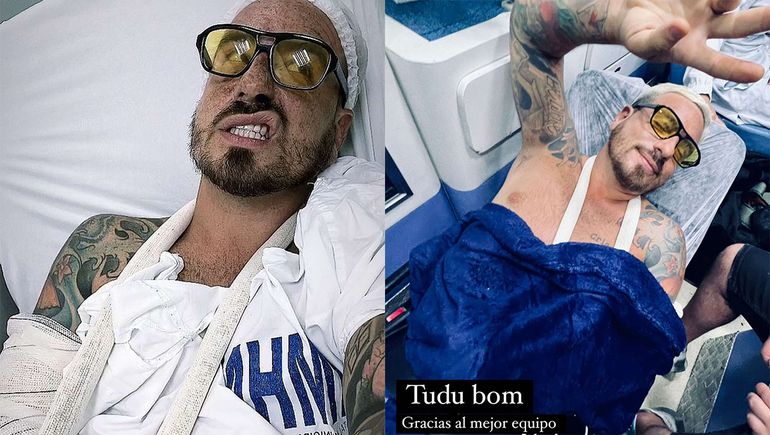 Mientras grababa en Brasil, Fede Bal sufrió una fractura expuesta en su brazo