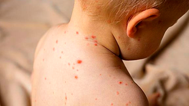 Argentina confirma casos de sarampión y Chile lanza una alerta epidemiológica. | LM Neuquen Argentina confirma casos de sarampión y Chile lanza una alerta epidemiológica.