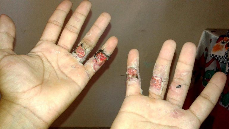 Las imágenes son elocuentes. El dedo de Tomás destrozado y las manos dañadas.