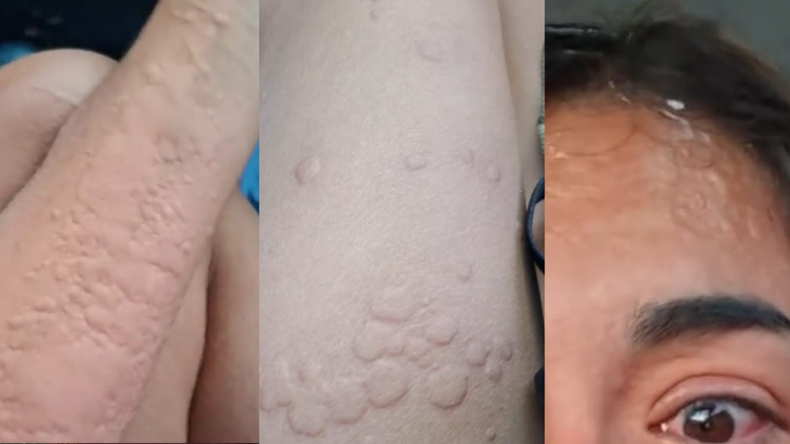 Una joven fue picada por una chaqueta amarilla y documentó toda la reacción que le provocó. | LM Neuquen Una joven fue picada por una chaqueta amarilla y documentó toda la reacción que le provocó.