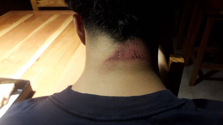 Una placa de yeso se desplomó sobre la nuca de un estudiante