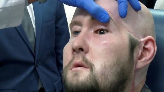Aaron James, el paciente que recibió un transplante de ojo en Nueva York.