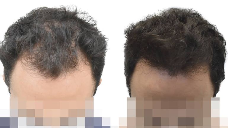 Crece un 21% la demanda de tratamientos capilares en Argentina