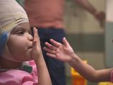 Las siamesas separadas en Brasil se recuperan favorablemente tras 27 horas de cirugía.