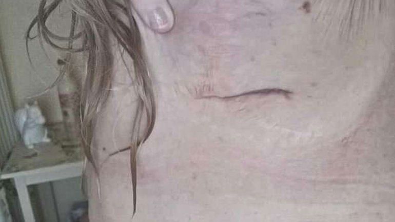 Tonia Rossington no aguantaba más los implantes mamarios pero no tenía las 3000 libras para la cirugía. Entonces