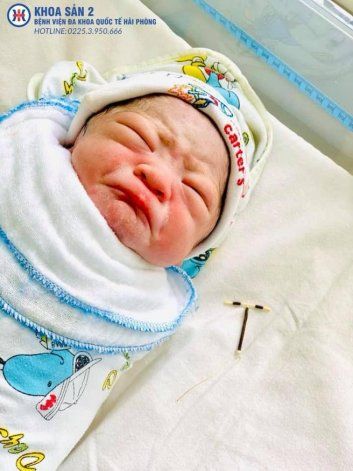 Un bebé nació en Vietnam con el DIU que se había puesto su madre