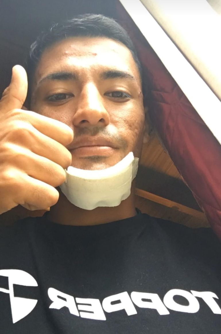 Santiago Jara y una foto que él mismo se sacó y envió a LM, mostrando su parche en el mentón pero también su buen estado general. Santiago Jara y una foto que él mismo se sacó y envió a LM, mostrando su parche en el mentón pero también su buen estado general.