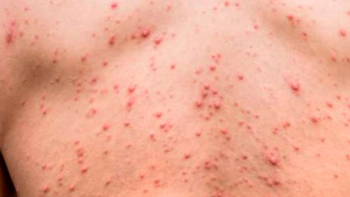 El sífilis es una enfermedad que, si no se trata, puede causar graves consecuencias. El sífilis es una enfermedad que, si no se trata, puede causar graves consecuencias.