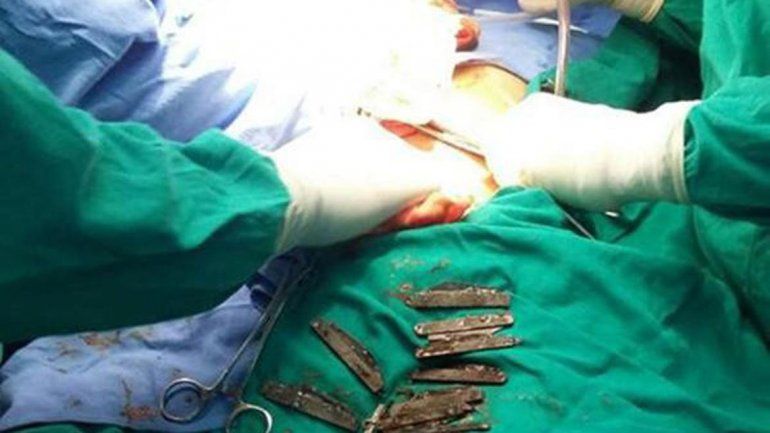 Increíble pero real: los cirujanos estuvieron cinco horas operando a este hombre al que le sacaron 40 navajas. Algunas de hasta 17 cm de largo.