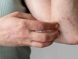 Picadura de mosquito: cómo saber si es de Dengue o de Encefalitis Equina