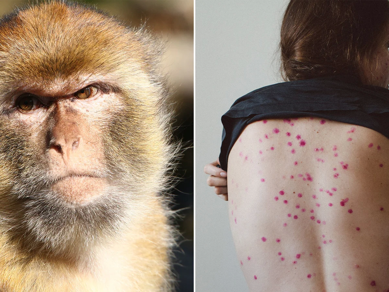 Viruela del mono: quiénes están en riesgo de contagio