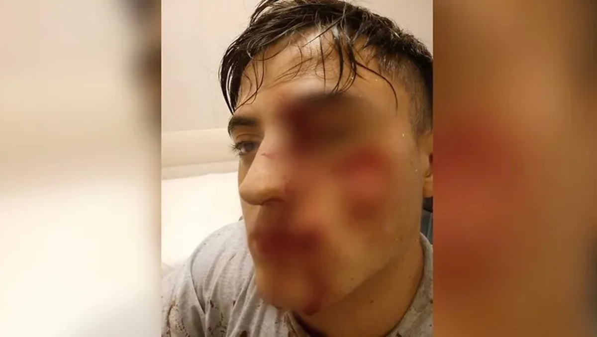 Vio a un amigo charlando con su exnovia y le cortó la cara con una botella rota